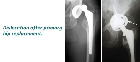 Revision Hip Replacement Surgery Ahmedabad Dr Rachit Sheth