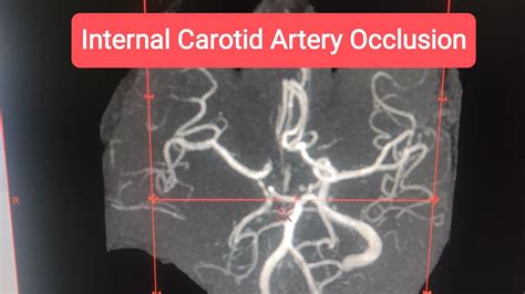 Internal Carotid Artery Occlusion Pathophysiology Diagnosis And My