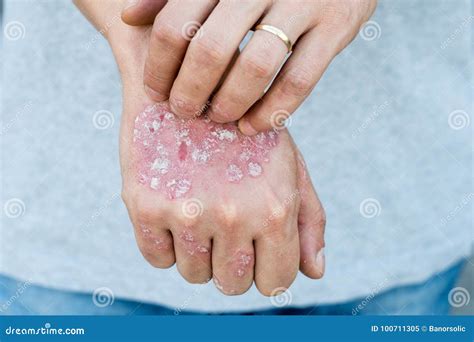 Man Scratch Oneself Dry Flaky Skin On Hand With Psoriasis Vulgaris