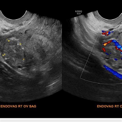 Transvaginal Ultrasound Of The Right Ovary In Sagittal And Coronal