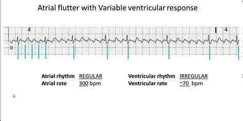 Atrial Flutter With Slow Ventricular Response