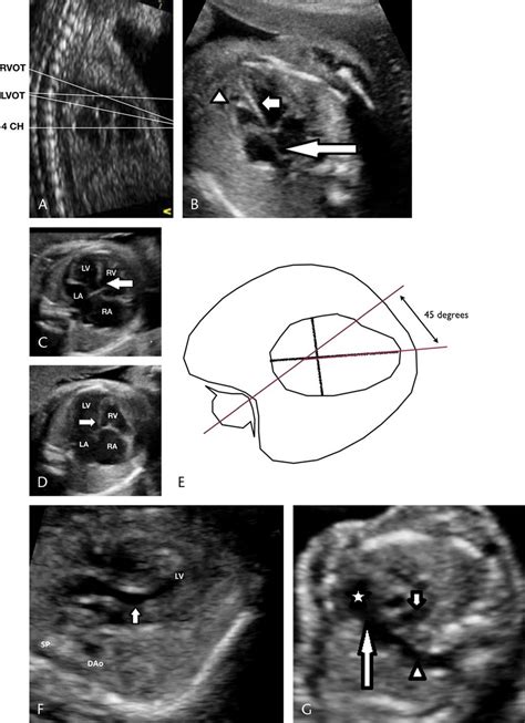 Fetal Heart Ultrasound