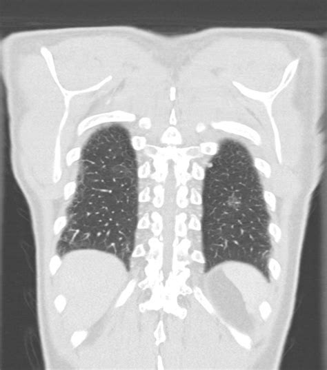 Pulmonary Cryptococcosis Image