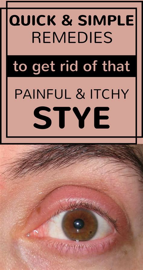 How To Get Rid Of A Stye Naturally Eye Stye Remedies Stye Skin Care Pimples