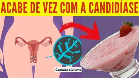 IncrÍvel Faça Apenas Isto E Elimine De Uma Vez Por Todas A Candidíase Candidíase Vaginal