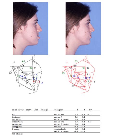 Corrective And Orthognathic Jaw Surgery Dr Richard W Joseph