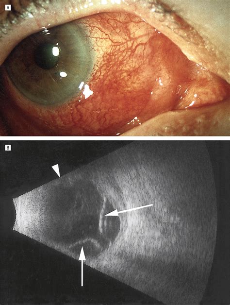 Microsporidia Induced Sclerouveitis With Retinal Detachment Jama