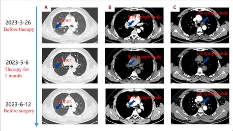 Figure From Neoadjuvant Lorlatinib Induces Pathological Complete