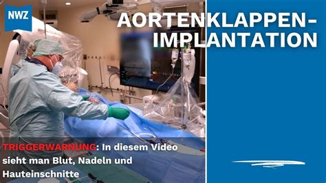 Operation Am Schlagenden Herzen Im Klinikum Oldenburg YouTube