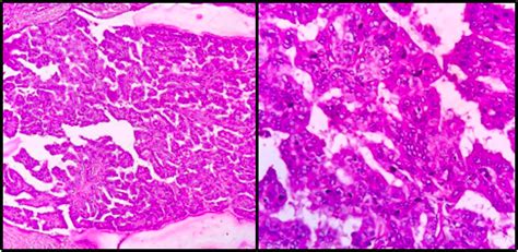 Papillary Thyroid Cancer Rare Variants And Cytohistopathological Correlation