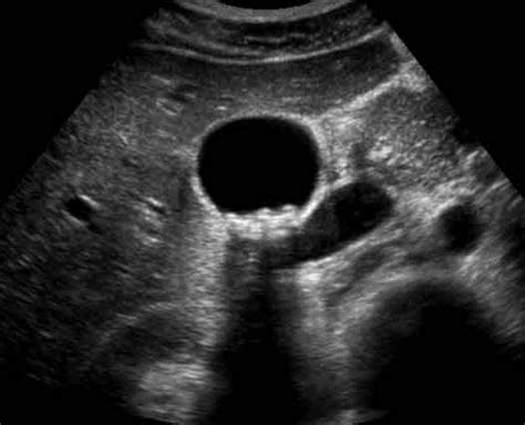 Gallbladder Ultrasound Stones