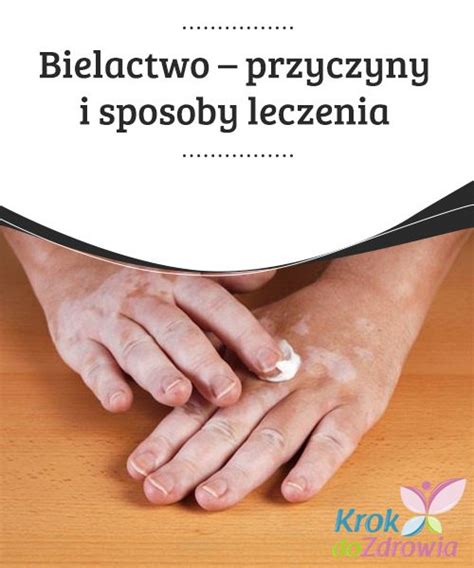 Bielactwo Przyczyny I Sposoby Leczenia Krok Do Zdrowia Hot Sex Picture