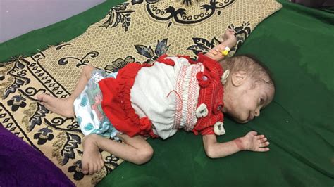 Children are starving to death and struggling without medication in Yemen - CBS News