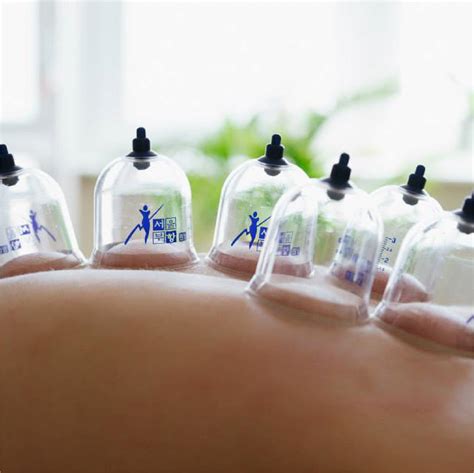 Introduction To Cupping Therapy And Body Gua Sha Jong Baik Education