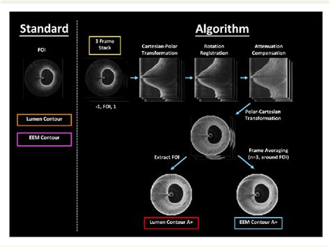 Figure From Plaque Burden Can Be Assessed Using Intravascular Optical