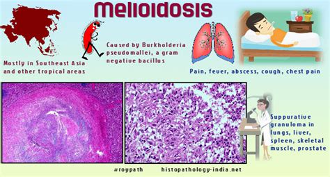 Pathology Of Melioidosis A Deadly Bacterial Disease Dr Sampurna Roy Md