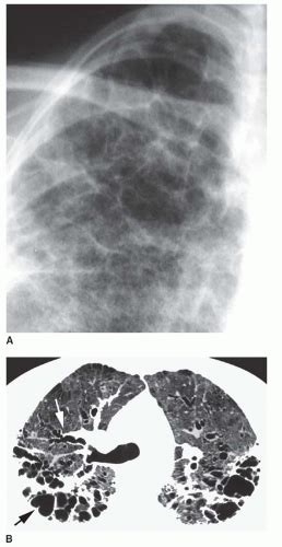 Diffuse Cystic Lung Diseases Radiology Key