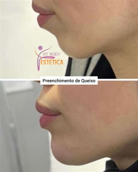 Preenchimento do Queixo Ácido Hialurônico Clínica Fit Body Estética