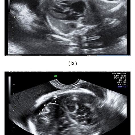 Pdf Prenatal Diagnosis Of Congenital Syphilis Using Two And Three