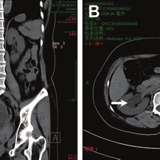 Computed Tomography Ct Findings Of Idiopathic Retroperitoneal