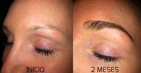 Minoxidil Para Sobrancelha Crescer Como Usar E O Antes E Depois