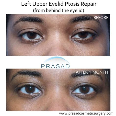 Asymmetrical Eyes When Surgery Is Recommended Dr Prasad