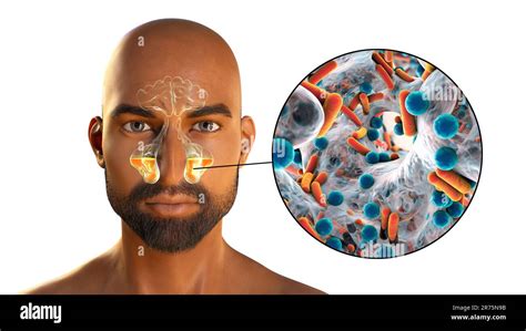 Sinusitis Inflammation Of Paranasal Cavities Computer Illustration