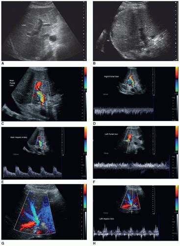 Organ Transplantation Radiology Key