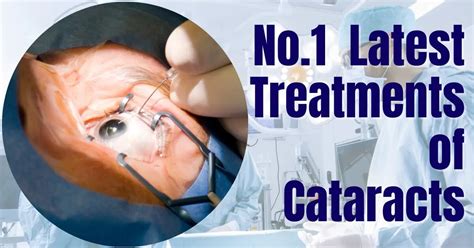 Latest No.1 Treatment of Cataracts: Exploring Options