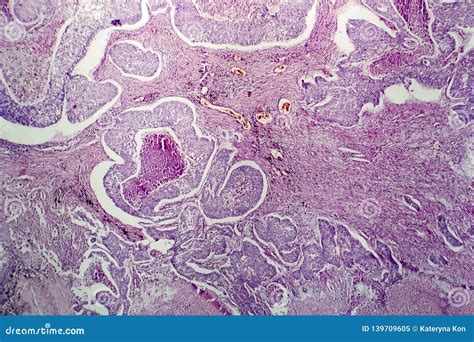 Ad Nocarcinome De Poumon Micrographe L Ger Image Stock Image Du