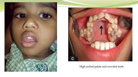 Presentation adenoidectomy | PPT