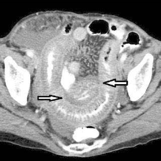 Double Contrast Ct Scan Of Abdomen With Arrows Showing Distal Ileal