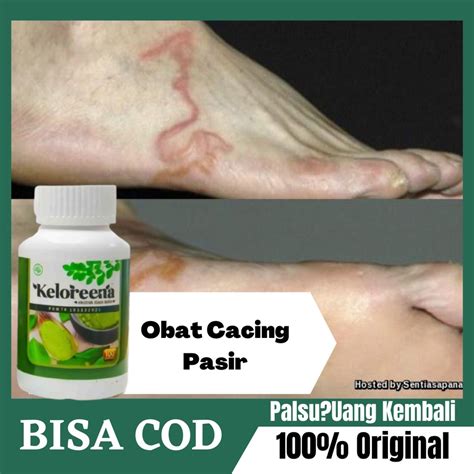 Jual Obat Cacing Pasir Cacing Tumbang Cutaneous Larva Migrans