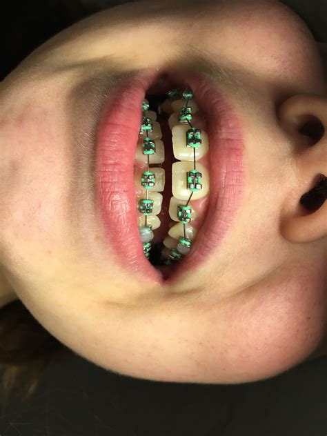 Green braces