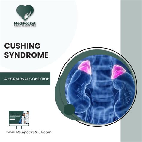 Cushing Syndrome Exploring This Hormonal Condition