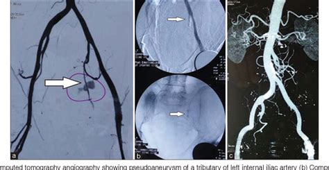 Figure From Internal Iliac Artery Pseudoaneurysm In Primary Total Hip