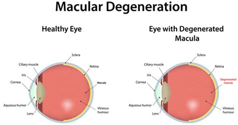 Understanding Macular Degeneration | Retina Macula Specialists of Miami