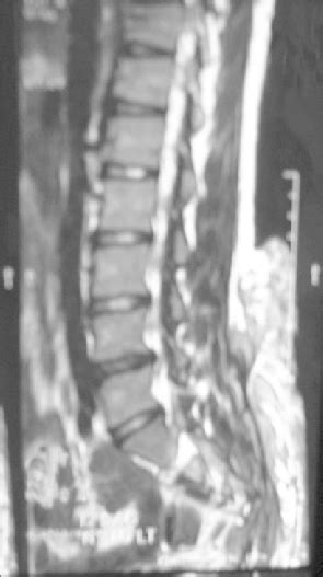 Sagittal T1 Weighted Magnetic Resonance Image Showing Lipomyelocele In