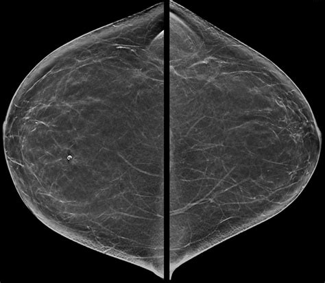 Practice Cases Mammoguide Learn Breast Imaging