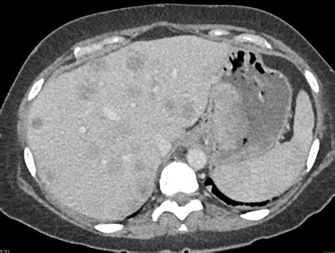 Liver Metastases Ct Scan