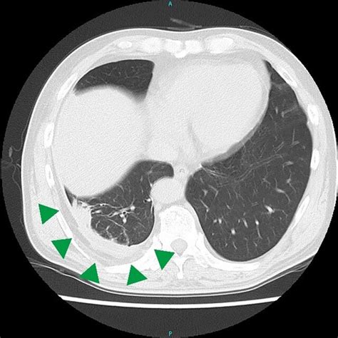 Chest Plain Computed Tomography Revealed A High‐density Area Along The