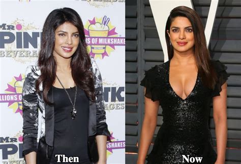 Priyanka Chopra Plastic Surgery Before And After Photos Latest