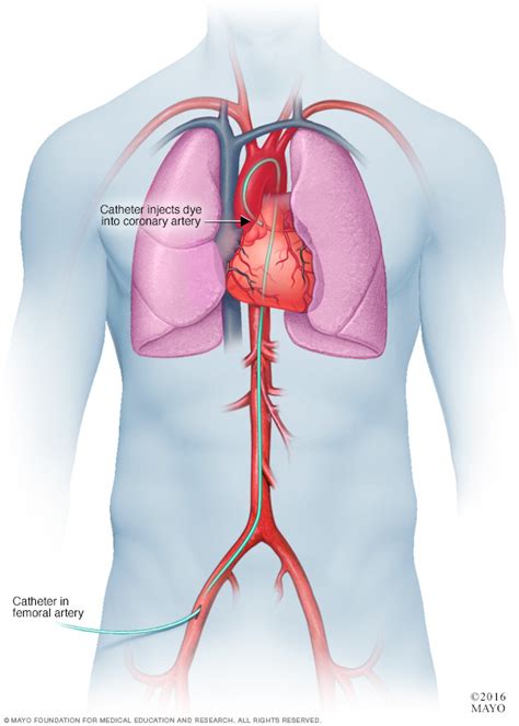 Spontaneous Coronary Artery Dissection Scad Disease Reference Guide