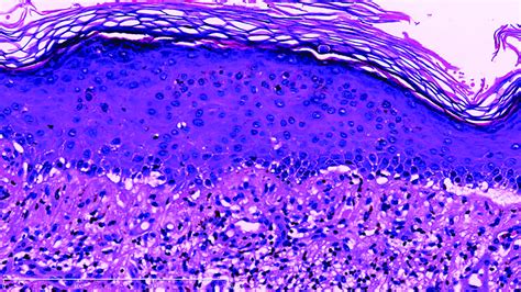 Mercury Induced Cutaneous Poisoning With Generalised Erythema And Pruritic Blister Indian