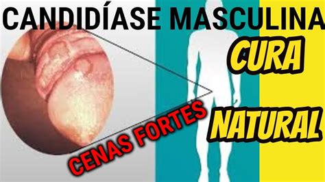 candidíase masculina tratamento caseiro candidíase masculina YouTube