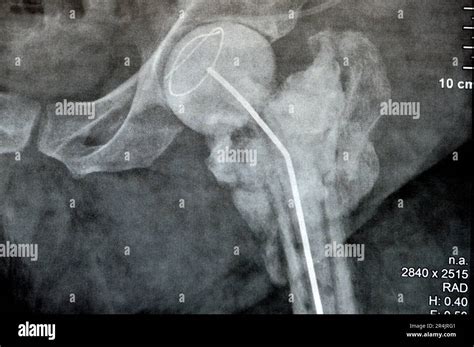 L articulation de la hanche à rayons X simple montre une fracture