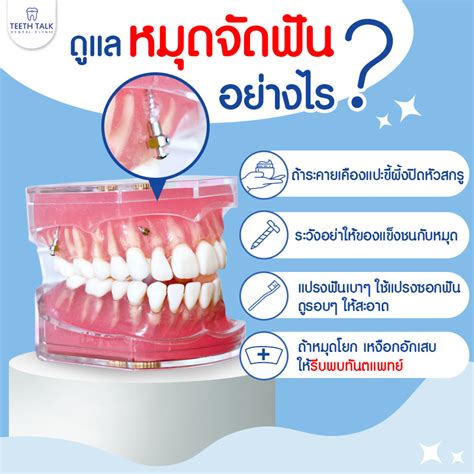 บอกหมดไม่กั๊ก ก่อนปักหมุดจัดฟัน Teeth Talk Dental Clinic