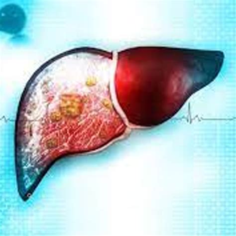 Liver Cancer Symptoms Signs Causes And Treatment Dr Punit Singla