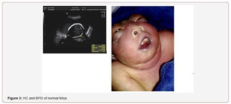 Discordance For Fetal Anencephaly In A Dichorionic Twin Pregnancy A Hot Sex Picture