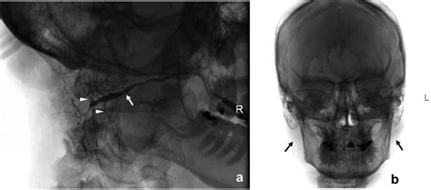 Lateral View Of Right Parotid Sialogram Showing Mild Narrowing Of The Download Scientific